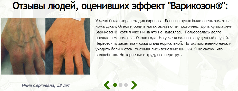 РЕАЛЬНЫЕ ОТЗЫВЫ О «Варикозон»2
